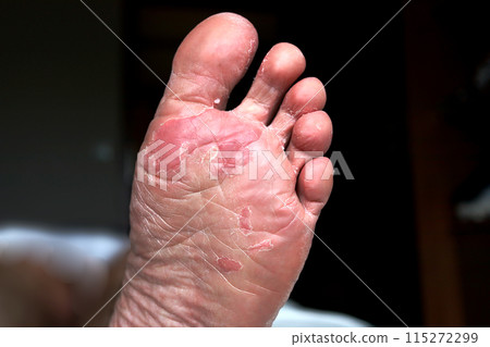Close up of dry feet. Peeling and cracked foot. Fungal infection or athlete's foot, dry skin, dermatitis, eczema, psoriasis, sweaty feet or dehydration. Health care concept. 115272299