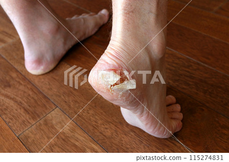 Close up of dry feet. Peeling and cracked foot. The skin peels off the heel. Fungal infection or athletes foot, dermatitis, psoriasis, sweaty feet or dehydration. 115274831