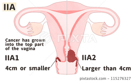 Cervical cancer stage ⅡA (stage 2A) Easy-to-understand English illustrations 115276327
