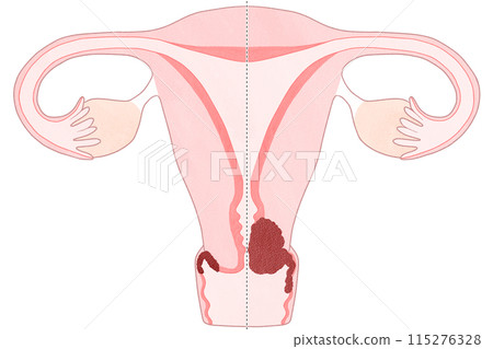 Cervical cancer stage ⅡA (stage 2A) Easy-to-understand illustration Cervical cancer stage ⅡA (stage 2A) Easy-to-understand illustration 115276328