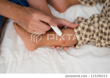 mother applying antiallergic cream on red spot at baby leg after red bite of mosquito 115289253