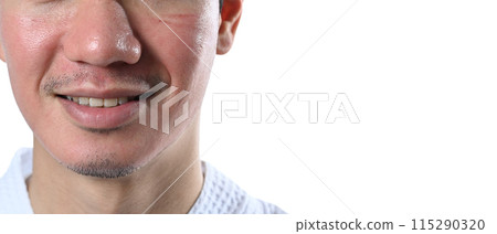 Skin healing period after CO2 laser resurfacing on white background. Medical dermatology concept 115290320