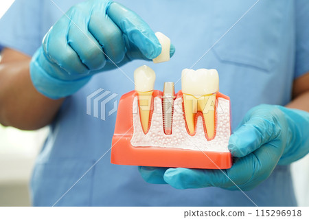 Doctor hold dental implant, artificial tooth roots into jaw, root canal of dental treatment, gum disease, teeth model for dentist studying about dentistry. Doctor hold dental implant, artificial tooth roots into jaw, root canal of dental treatment, gum disease, teeth model for dentist studying about dentistry. 115296918