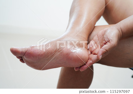 Asian woman applying moisturizing cream skincare treatment to solve and repair feet with crack and dry heel skin. Asian woman applying moisturizing cream skincare treatment to solve and repair feet with crack and dry heel skin. 115297097