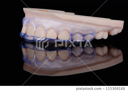 3D printed transparent dental template for gum correction fixed on model on black background. 115309188
