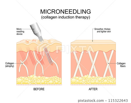 Microneedling procedure. Skin rejuvenation 115322643