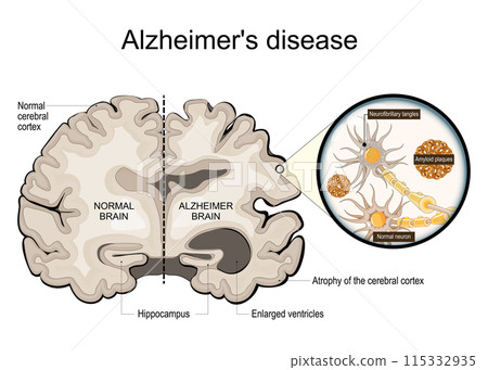 Alzheimer disease. Hippocampus. Close-up of neurons with Neurofibrillary tangles, Amyloid plaques Alzheimer disease. Hippocampus. Close-up of neurons with Neurofibrillary tangles, Amyloid plaques 115332935