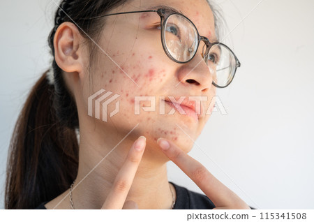 Cropped shot view of unhappy Asian woman having problems of acne inflammation (Papule and Pustule) on her face. Conceptual of problems on woman skin. 115341508