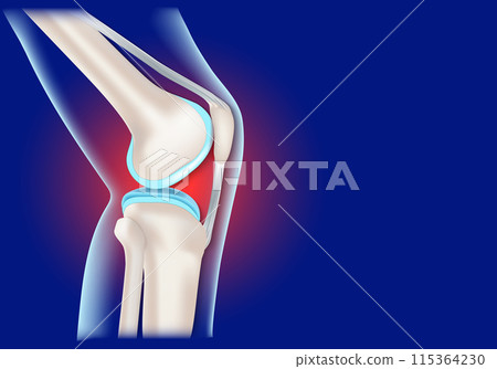 Knee joint inflammation. Realistic human knee 115364230