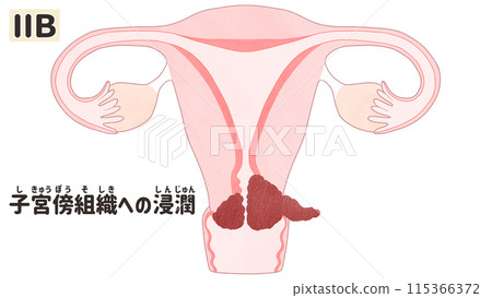 Cervical cancer stage II B (stage 2B) - Easy-to-understand Japanese illustrations Cervical cancer stage II B (stage 2B) - Easy-to-understand Japanese illustrations 115366372