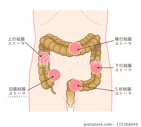 結腸造口術，造口，大腸，插圖，插圖 115368649