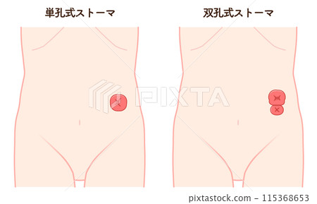 結腸造口術，造口，大腸，插圖，插圖 115368653