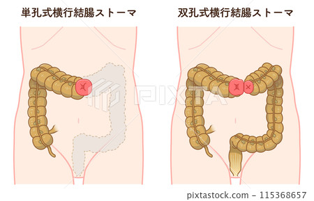Colostomy, stoma, colon, illustration Colostomy, stoma, colon, illustration 115368657