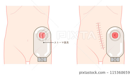 Colostomy, stoma, colon, illustration 115368659