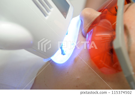 close-up of a woman's face under the apparatus Beyond Poluse Plus Advanced Whitening System with Dental UV Laser Whitening Device in glasses protective against ultraviolet whitening teeth 115374502
