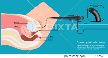 Cystoscopy used to examine urethra and bladder. 115377520