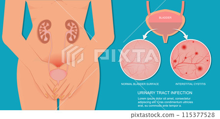 Urinary tract infection is a very common type of infection in urinary system. 115377528