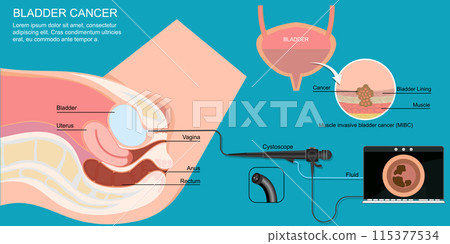 Evaluation of diagnostic strategies for bladder cancer using cystoscopy. 115377534