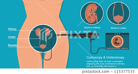 During a cystoscopy, the doctor passes the tube into the bladder. 115377535