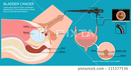 Cystoscopy enables the inside of the urethra and bladder to be examined and sampled. 115377536