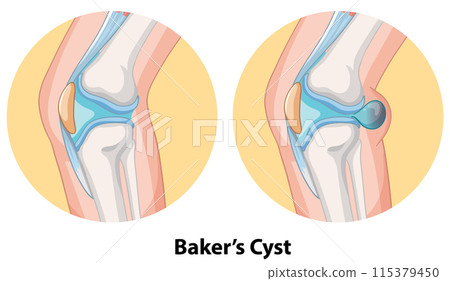 Baker's Cyst in Knee Joint Baker's Cyst in Knee Joint 115379450