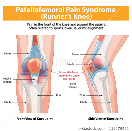 Patellofemoral Pain Syndrome Illustration Patellofemoral Pain Syndrome Illustration 115379451