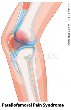 Patellofemoral Pain Syndrome Illustration Patellofemoral Pain Syndrome Illustration 115379454
