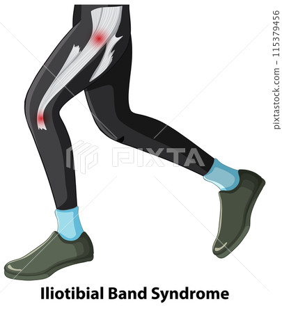 Iliotibial Band Syndrome Illustration 115379456