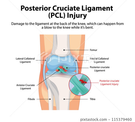 Posterior Cruciate Ligament Injury Diagram 115379460