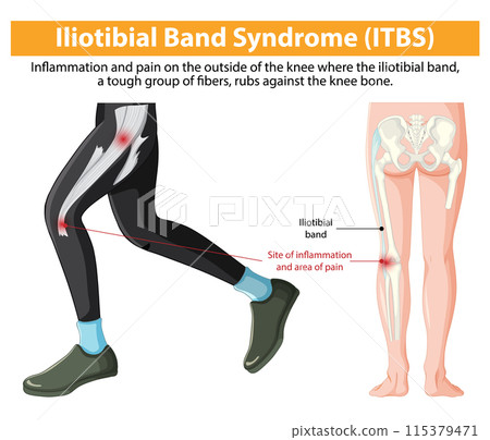 Iliotibial Band Syndrome (ITBS) Illustration 115379471