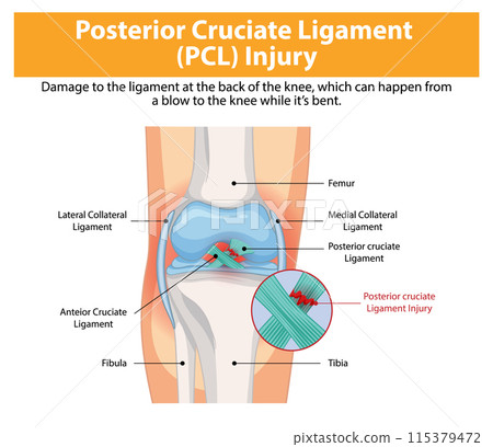 Posterior Cruciate Ligament (PCL) Injury 115379472