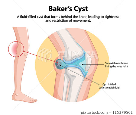 Baker's Cyst in the Knee 115379501
