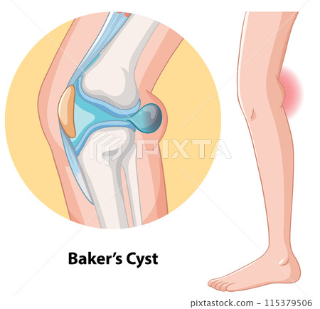 Baker's Cyst in the Knee 115379506