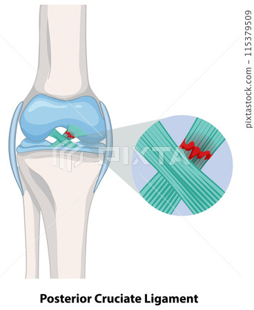 Posterior Cruciate Ligament Injury 115379509