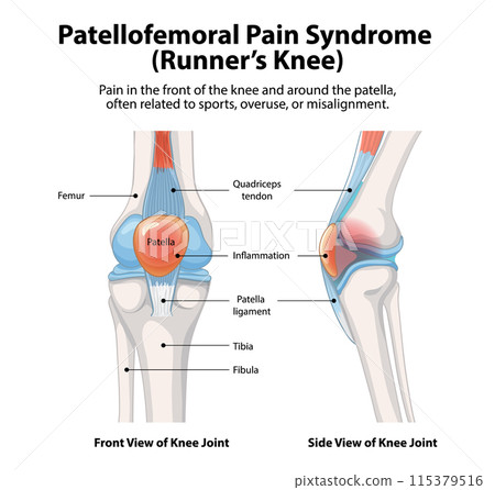 Patellofemoral Pain Syndrome Illustration 115379516