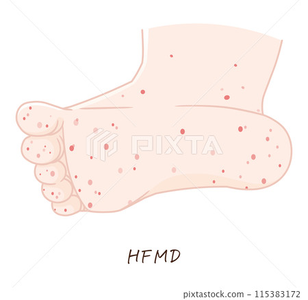 Hand, foot and mouth disease illustration, HFMD, illustration 115383172