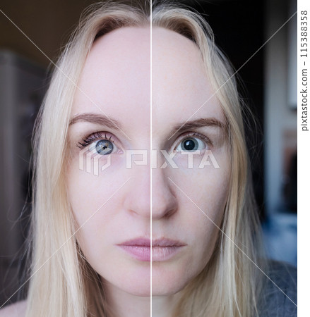 Before and after eye drops to examine the fundus, pupil dilation. Doctor performs an ophthalmoscopy on a woman who has mydriasis and accommodation spasm. Poor vision and paralysis of the eye muscles Before and after eye drops to examine the fundus, pupil dilation. Doctor performs an ophthalmoscopy on a woman who has mydriasis and accommodation spasm. Poor vision and paralysis of the eye muscles 115388358