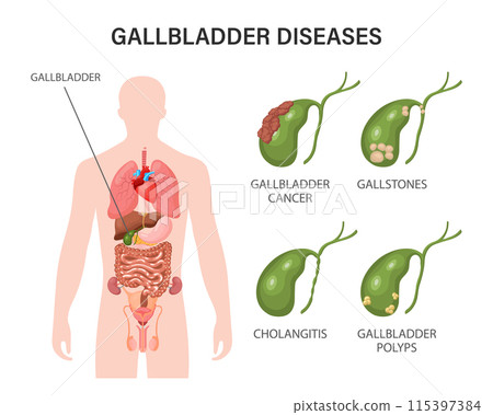 Gallbladder diseases infographics. Gallstone disease, cancer, acute cholecystitis, cholangitis or polyps of the digestive system. Problems with the biliary tract. Illustration. 115397384