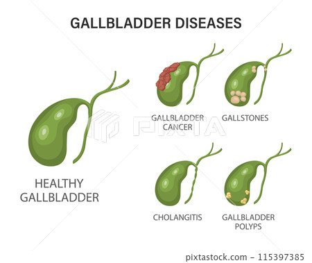 Gallbladder diseases infographics. Gallstone disease, cancer, acute cholecystitis, cholangitis or polyps of the digestive system. Problems with the biliary tract. Illustration. 115397385
