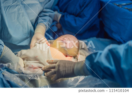 A baby is delivered in an intact amniotic sac during a caesarean section. The medical team carefully performs the procedure, highlighting the precision and care involved in this unique birth scenario 115410104