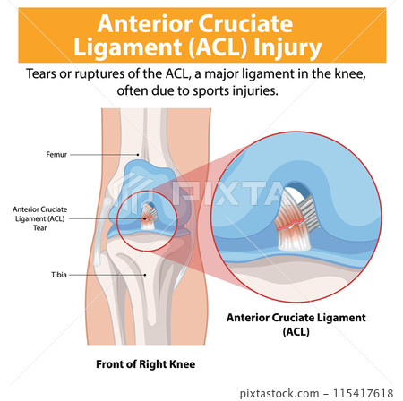 Anterior Cruciate Ligament (ACL) Injury 115417618