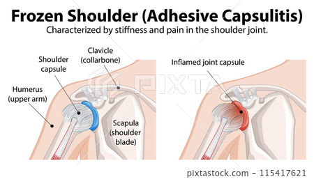 Frozen Shoulder Medical Illustration 115417621