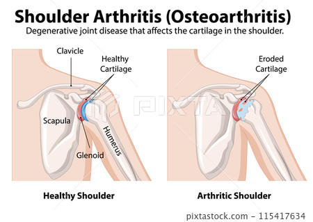 Shoulder Arthritis Comparison Illustration Shoulder Arthritis Comparison Illustration 115417634