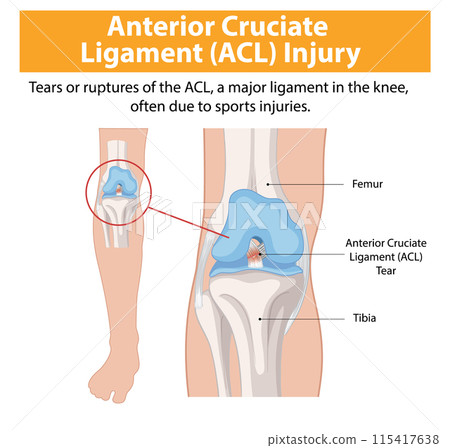 Anterior Cruciate Ligament (ACL) Injury 115417638