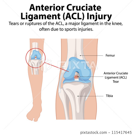 Anterior Cruciate Ligament (ACL) Injury 115417645