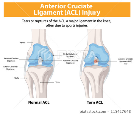 Anterior Cruciate Ligament (ACL) Injury Anterior Cruciate Ligament (ACL) Injury 115417648