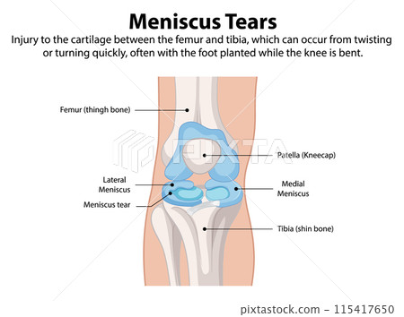 Meniscus Tears in the Knee Meniscus Tears in the Knee 115417650
