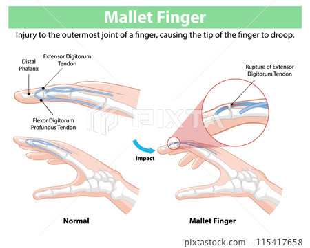Mallet Finger Injury Illustration Mallet Finger Injury Illustration 115417658