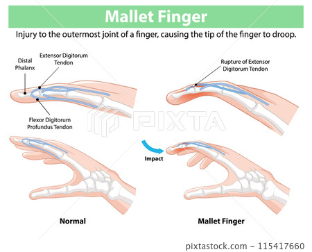 Mallet Finger Injury Illustration 115417660