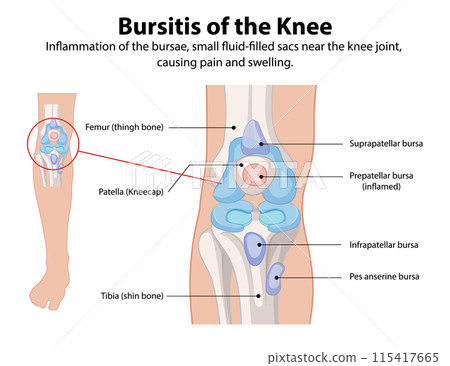 Bursitis of the Knee Illustration 115417665